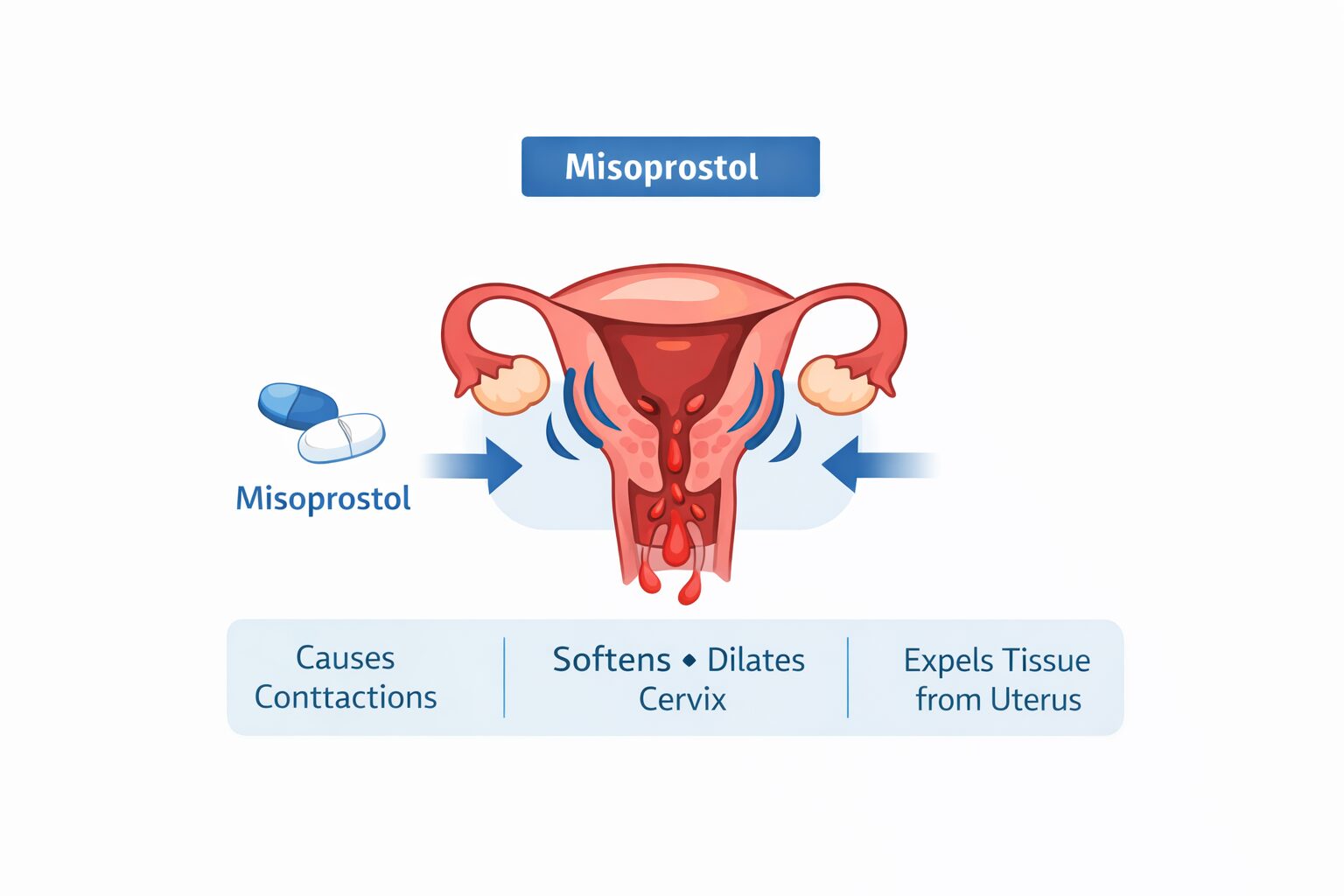 What Does Misoprostol Do to the Uterus